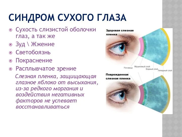 СИНДРОМ СУХОГО ГЛАЗА Сухость слизистой оболочки глаз, а так же