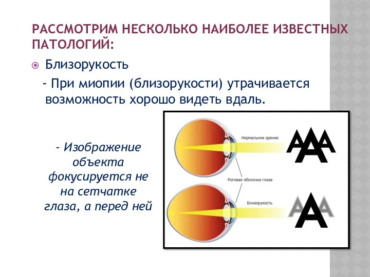 РАССМОТРИМ НЕСКОЛЬКО НАИБОЛЕЕ ИЗВЕСТНЫХ ПАТОЛОГИЙ: Близорукость - При миопии (близорукости)