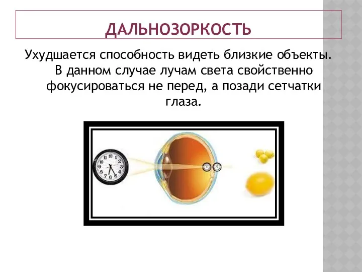 ДАЛЬНОЗОРКОСТЬ Ухудшается способность видеть близкие объекты. В данном случае лучам