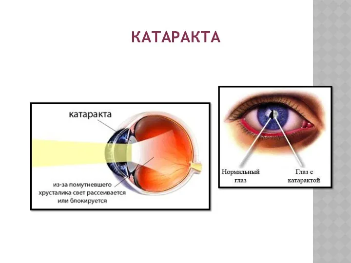КАТАРАКТА Патология глаз, которая характеризуется помутнением хрусталика.