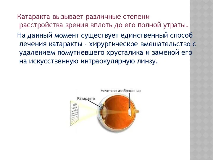 Катаракта вызывает различные степени расстройства зрения вплоть до его полной