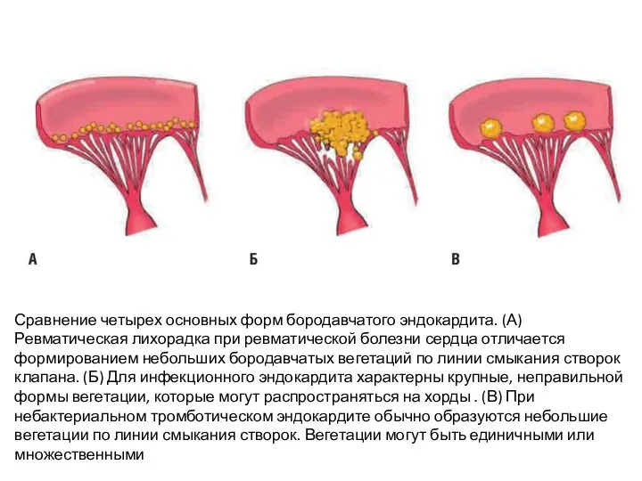 Сравнение четырех основных форм бородавчатого эндокардита. (А) Ревматическая лихорадка при