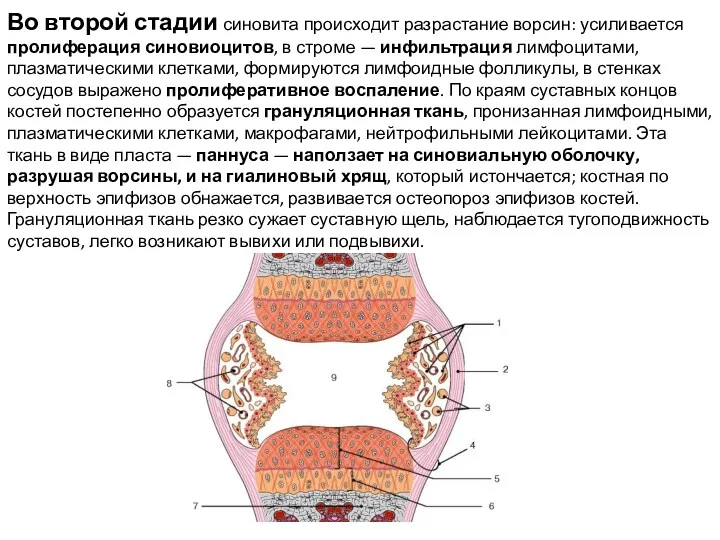 Во второй стадии синовита происходит разрас­тание ворсин: усиливается пролиферация синовиоцитов,