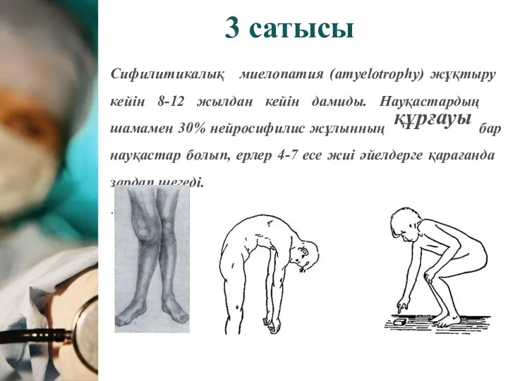 3 сатысы Сифилитикалық миелопатия (amyelotrophy) жұқтыру кейін 8-12 жылдан кейін