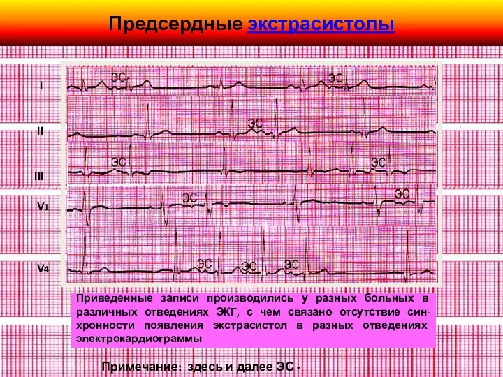 Предсердные экстрасистолы I II III V1 V4 Примечание: здесь и