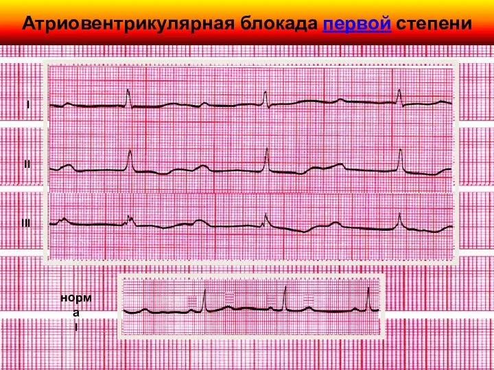 Атриовентрикулярная блокада первой степени норма I I II III