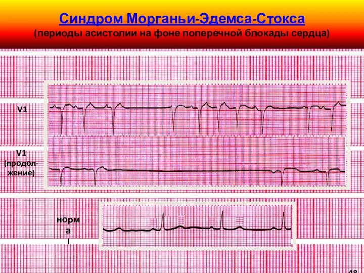 Синдром Морганьи-Эдемса-Стокса (периоды асистолии на фоне поперечной блокады сердца) норма I V1 V1 (продол-жение) 48