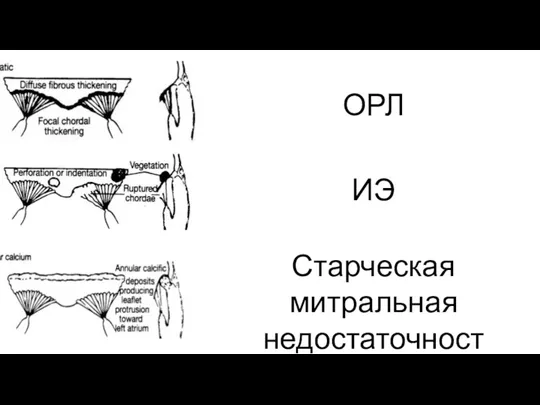 ОРЛ ИЭ Старческая митральная недостаточность