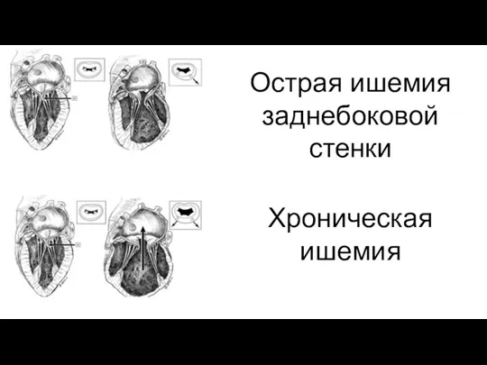 Острая ишемия заднебоковой стенки Хроническая ишемия