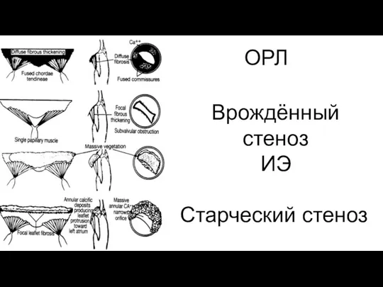 ОРЛ Врождённый стеноз ИЭ Старческий стеноз