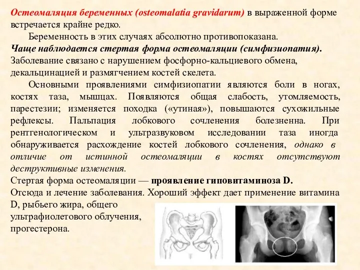 Остеомаляция беременных (osteomalatia gravidarum) в выраженной форме встречается крайне редко.