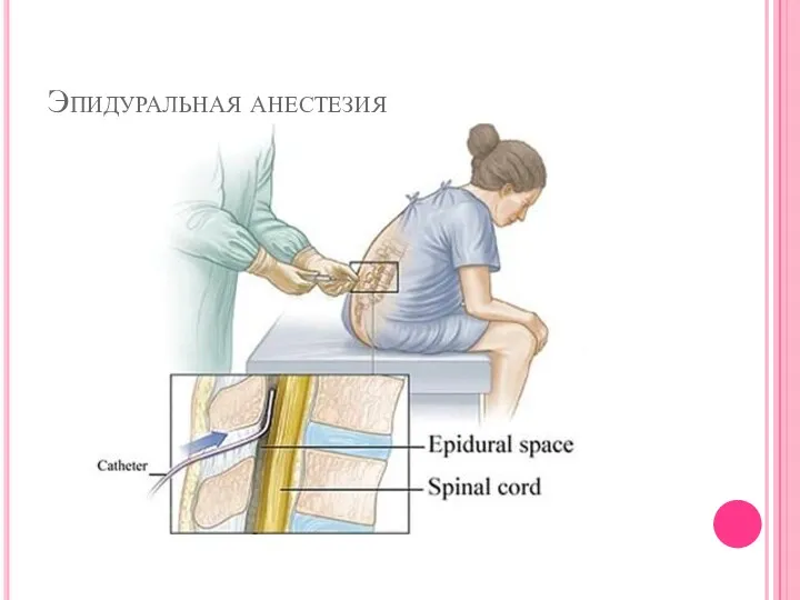 Эпидуральная анестезия