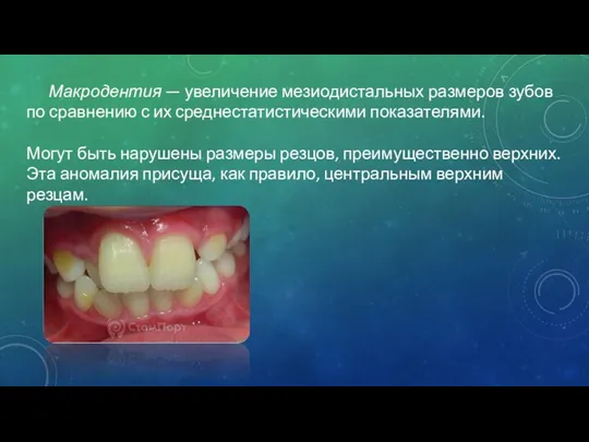 Макродентия — увеличение мезиодистальных размеров зубов по сравнению с их