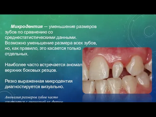 Микродентия — уменьшение размеров зубов по сравнению со среднестатистическими данными.