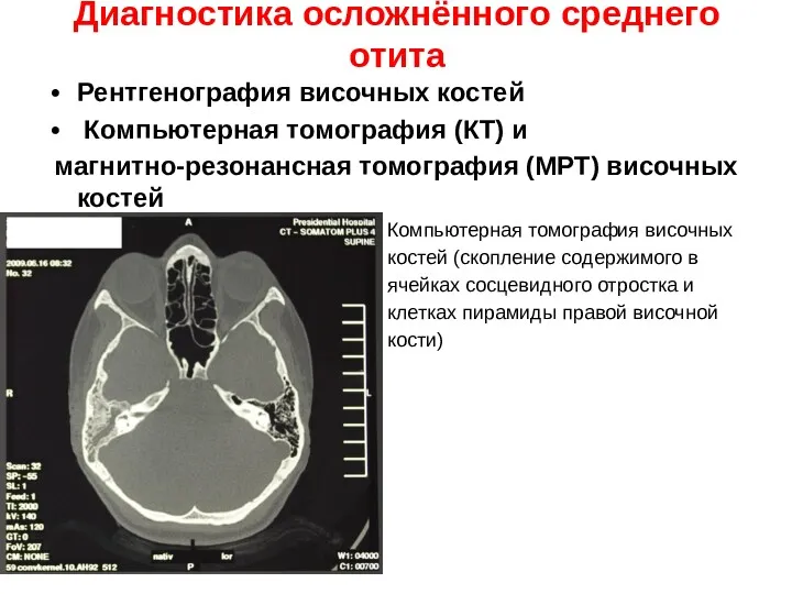 Диагностика осложнённого среднего отита Рентгенография височных костей Компьютерная томография (КТ)
