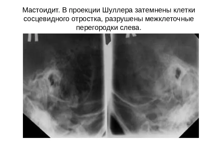 Мастоидит. В проекции Шуллера затемнены клетки сосцевидного отростка, разрушены межклеточные перегородки слева.