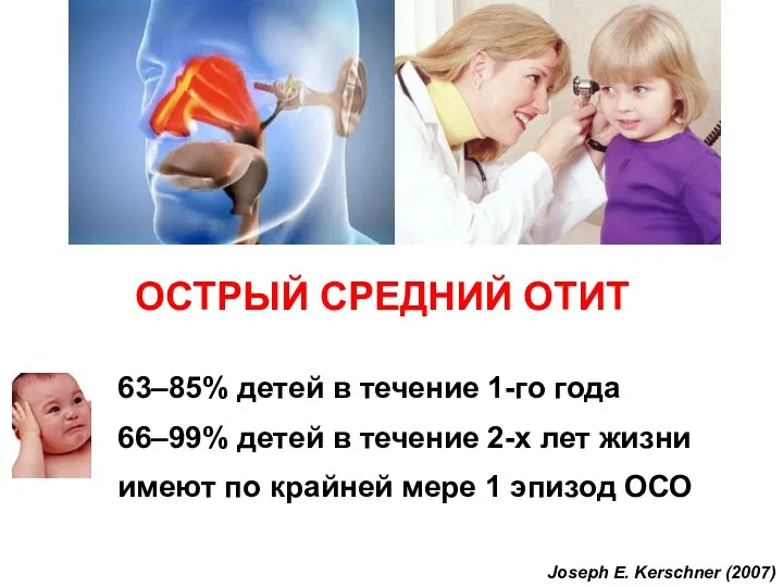 ОСТРЫЙ СРЕДНИЙ ОТИТ 63–85% детей в течение 1-го года 66–99%