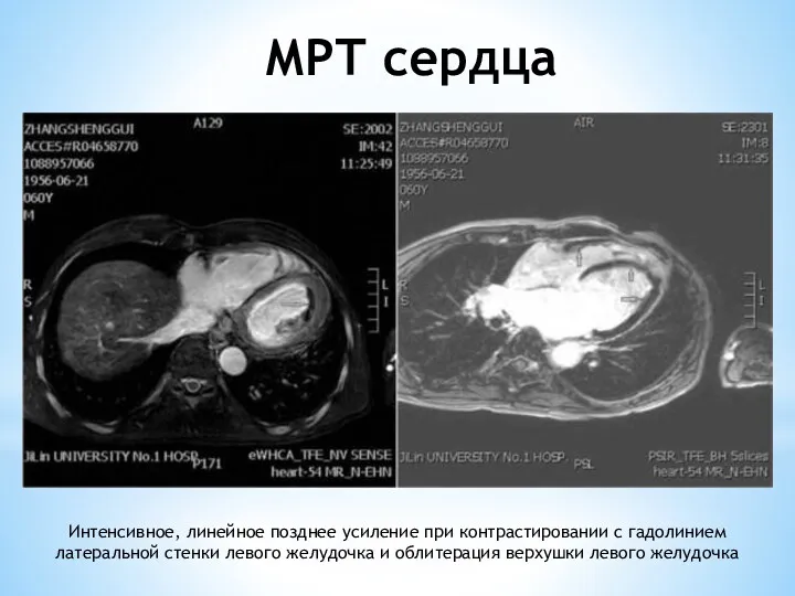 МРТ сердца Интенсивное, линейное позднее усиление при контрастировании с гадолинием