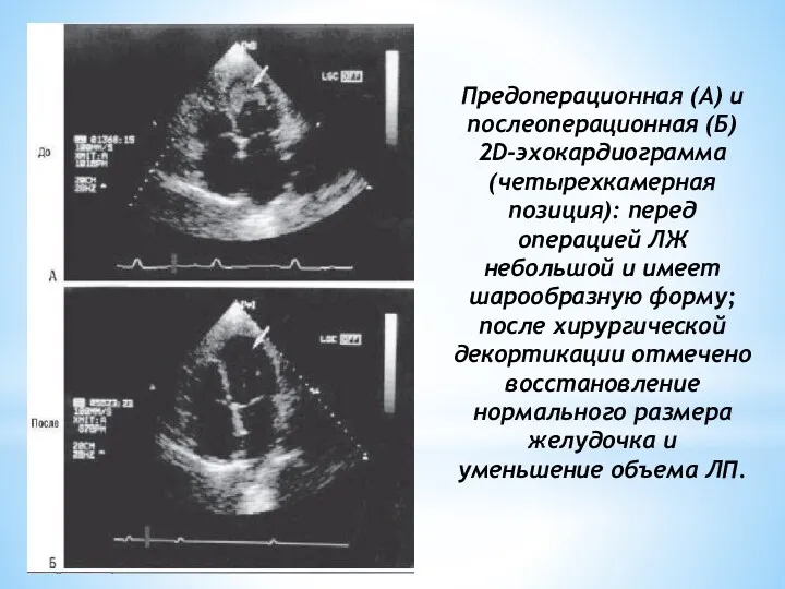 Предоперационная (А) и послеоперационная (Б) 2D-эхокардиограмма (четырехкамерная позиция): перед операцией