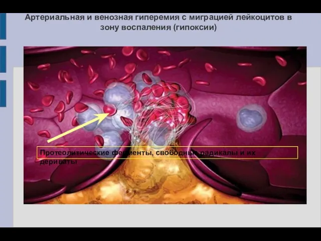 Артериальная и венозная гиперемия с миграцией лейкоцитов в зону воспаления (гипоксии) Протеолитические ферменты,