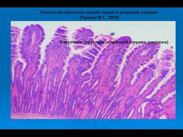 Клеточная структура сохранена (период гипоксии) Слизистая оболочка тонкой кишки в условиях ишемии (Чуприс В.Г., 2010)
