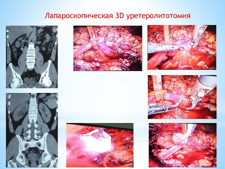 Лапароскопическая 3D уретеролитотомия