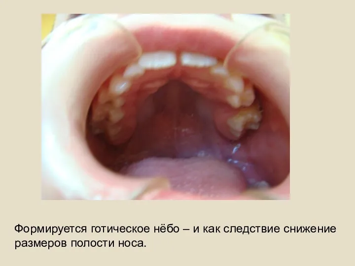 Формируется готическое нёбо – и как следствие снижение размеров полости носа.