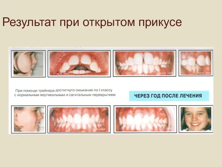 Результат при открытом прикусе