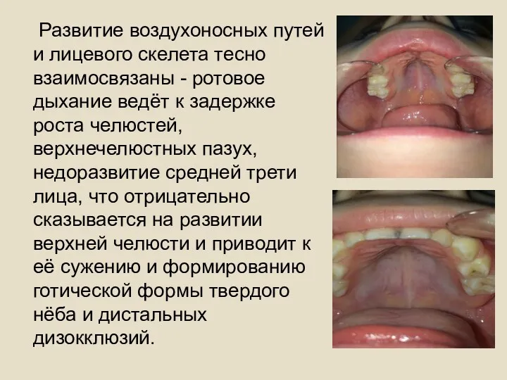 Развитие воздухоносных путей и лицевого скелета тесно взаимосвязаны - ротовое