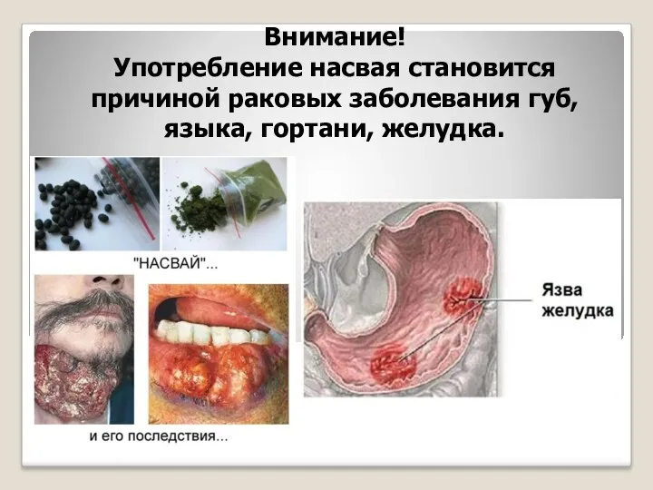 Внимание! Употребление насвая становится причиной раковых заболевания губ, языка, гортани, желудка.