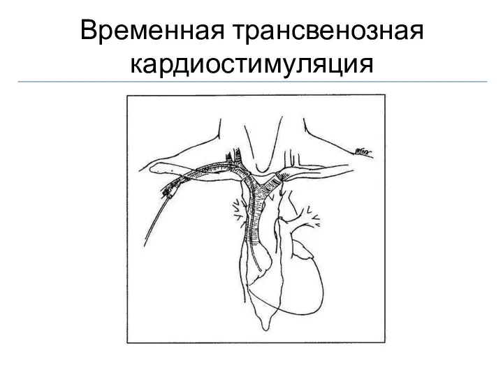 Временная трансвенозная кардиостимуляция