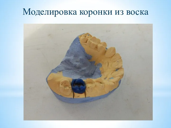 Моделировка коронки из воска