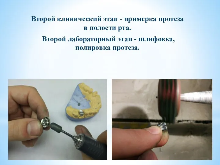 Второй клинический этап - примерка протеза в полости рта. Второй лабораторный этап - шлифовка, полировка протеза.