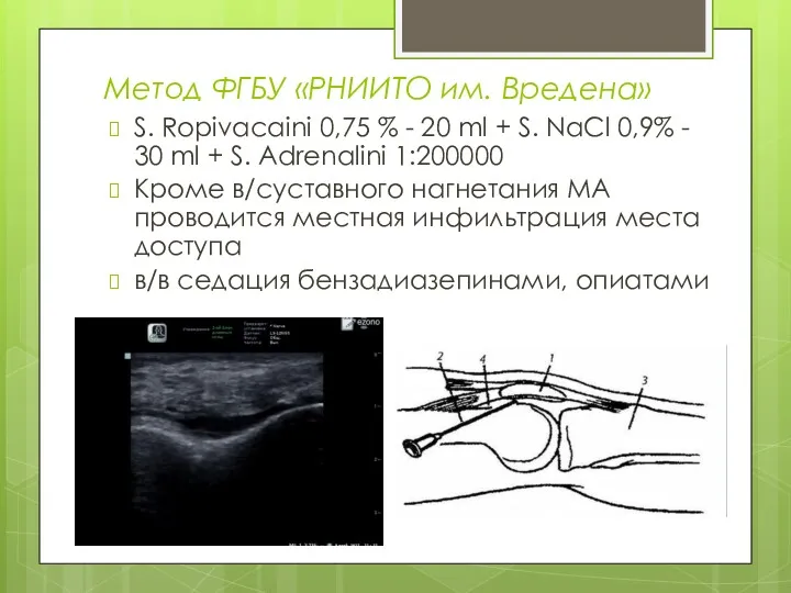 Метод ФГБУ «РНИИТО им. Вредена» S. Ropivacaini 0,75 % -