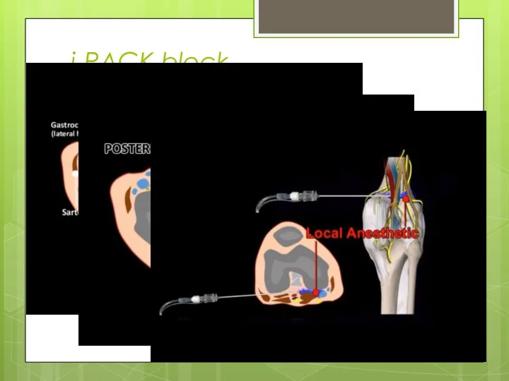 i-PACK block local anesthetic infiltration between the popliteal artery and