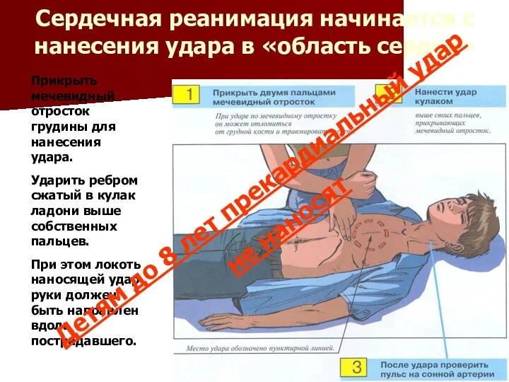 Сердечная реанимация начинается с нанесения удара в «область сердца» Прикрыть