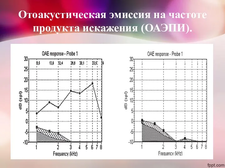 Отоакустическая эмиссия на частоте продукта искажения (ОАЭПИ).