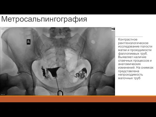 Метросальпингография Контрастное рентгенологическое исследование полости матки и проходимости фаллопиевых труб. Выявляет наличие спаечных