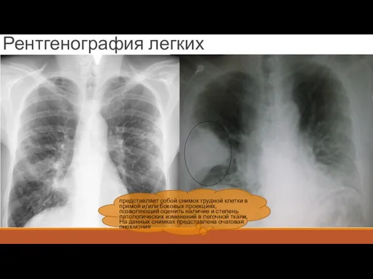 Рентгенография легких представляет собой снимок грудной клетки в прямой и/или боковых проекциях, позволяющий
