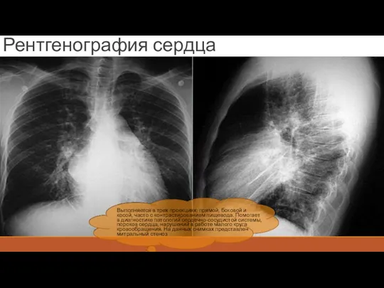 Рентгенография сердца Выполняется в трех проекциях: прямой, боковой и косой, часто с контрастированием