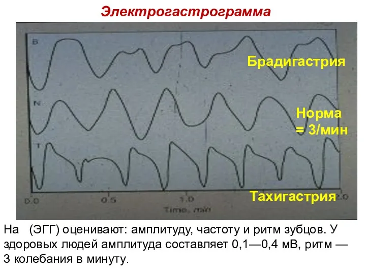 Электрогастрограмма Норма = 3/мин Брадигастрия Тахигастрия На (ЭГГ) оценивают: амплитуду,