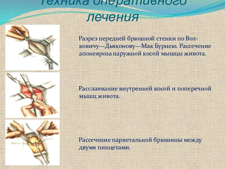 Техника оперативного лечения Разрез передней брюшной стенки по Вол-ковичу—Дьяконову—Мак Бурнею.