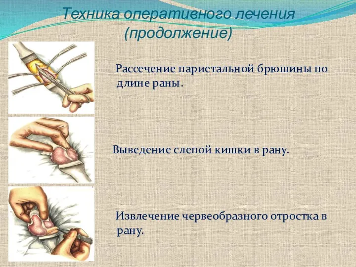 Техника оперативного лечения(продолжение) Рассечение париетальной брюшины по длине раны. Выведение