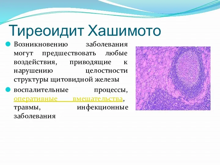 Тиреоидит Хашимото Возникновению заболевания могут предшествовать любые воздействия, приводящие к