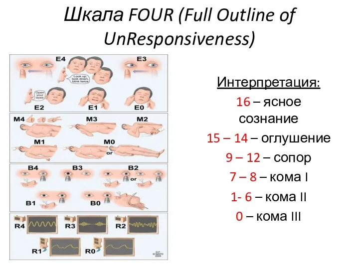 Шкала FOUR (Full Outline of UnResponsiveness) Интерпретация: 16 – ясное сознание 15 –
