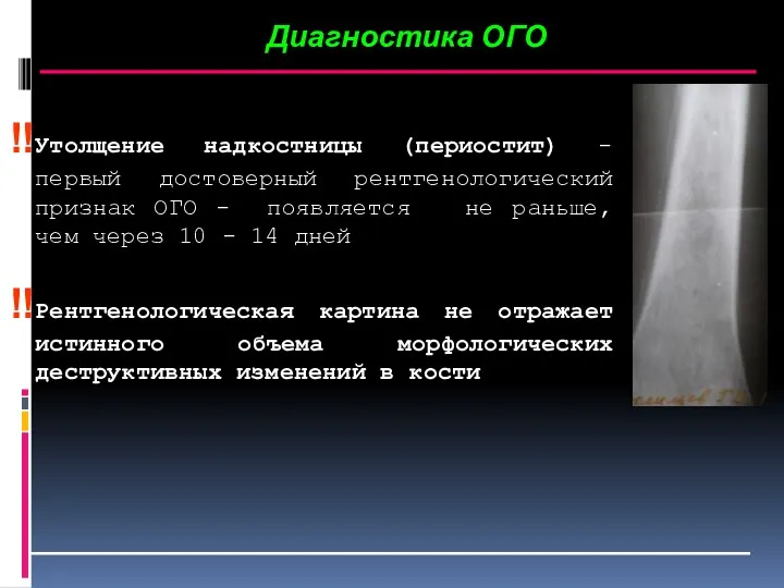 Диагностика ОГО Утолщение надкостницы (периостит) - первый достоверный рентгенологический признак