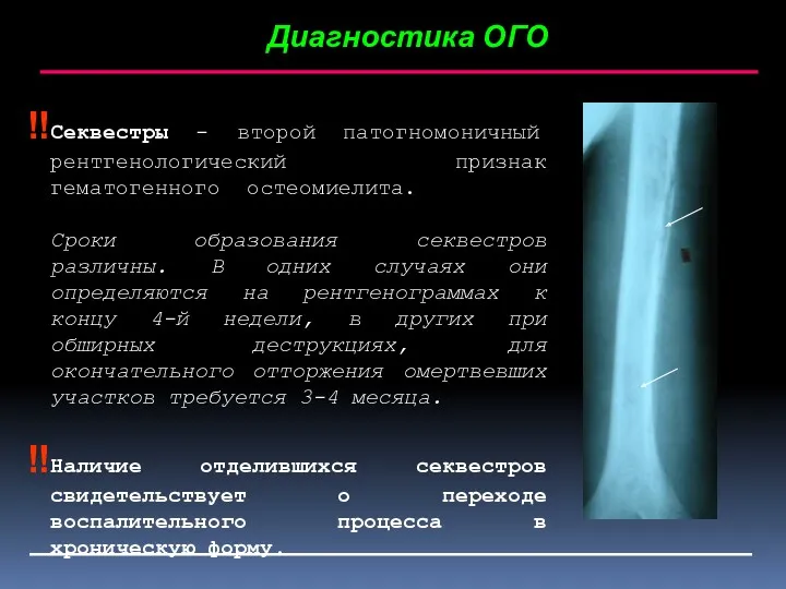 Диагностика ОГО Секвестры - второй патогномоничный рентгенологический признак гематогенного остеомиелита.
