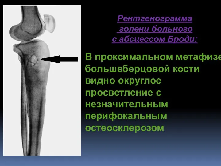 Рентгенограмма голени больного с абсцессом Броди: В проксимальном метафизе большеберцовой