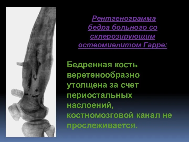 Рентгенограмма бедра больного со склерозирующим остеомиелитом Гарре: Бедренная кость веретенообразно