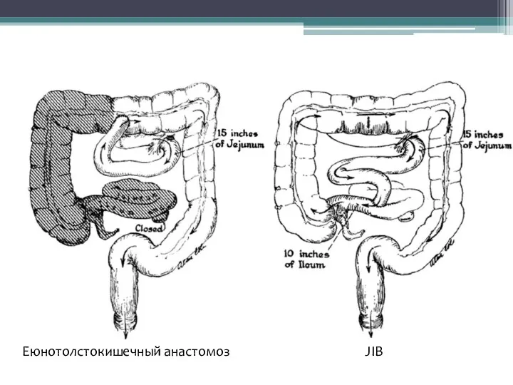 JIB Еюнотолстокишечный анастомоз